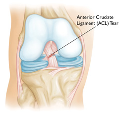 ACL Rupture